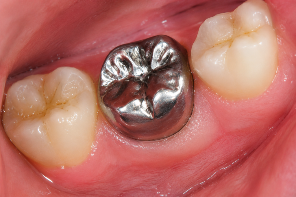 Stainless steel crowns for kids seated on primary molars